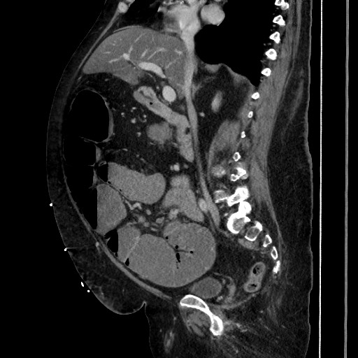 Obstructive colonic diverticular stricture (Radiopaedia 81085-94675 C 110).jpg