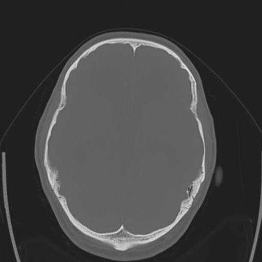 File:Obstructive hydrocephalus (Radiopaedia 30453-31119 Axial bone window 20).jpg
