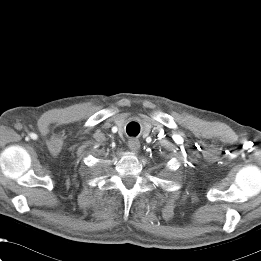 File:Obstructive superior vena cava tumor thrombus (Radiopaedia 28046-28306 A 3).jpg