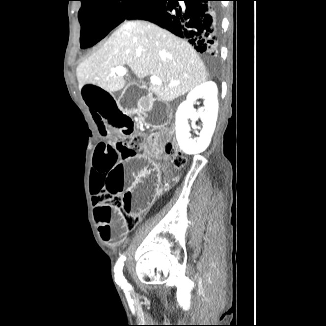 Obturator hernia causing small bowel obstruction (Radiopaedia 65522-74612 C 72).jpg