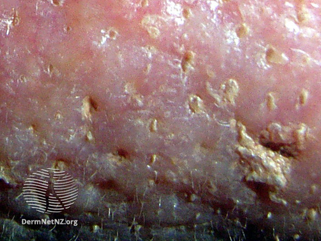 Rosacea (DermNet NZ acne-red-face-3637).jpg