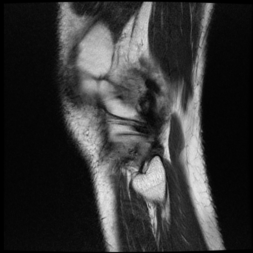 File:ACL acute full thickness tear - deep lateral femoral sulcus sign (Radiopaedia 38594-40740 Sagittal T2 20).jpg
