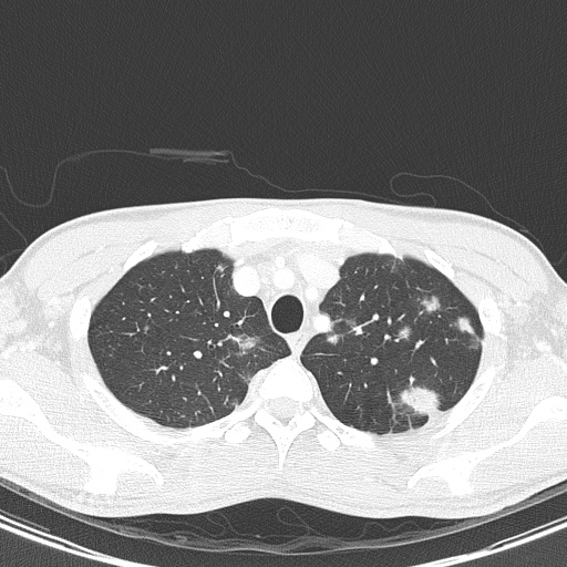 AIDS-related Kaposi sarcoma (Radiopaedia 85247-100811 Axial lung window 31).jpg