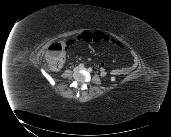 File:Abdominal abscess - pre and post percutaneous drainage (Radiopaedia 60209-67816 Axial 42).png