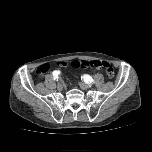Abdominal aortic aneurysm (Radiopaedia 13341-13340 Axial C+ arterial phase 184).jpg