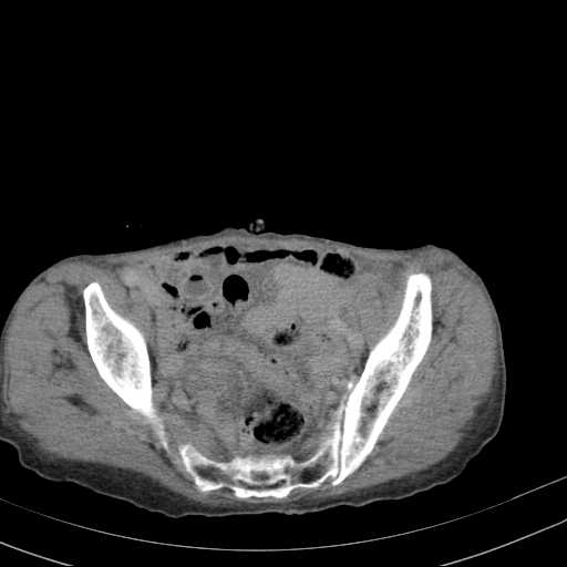 File:Abdominal aortic aneurysm (Radiopaedia 20827-20742 Axial C+ delayed 30).jpg