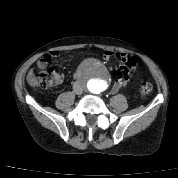 Abdominal aortic aneurysm (Radiopaedia 29248-29660 Axial C+ arterial phase 57).jpg