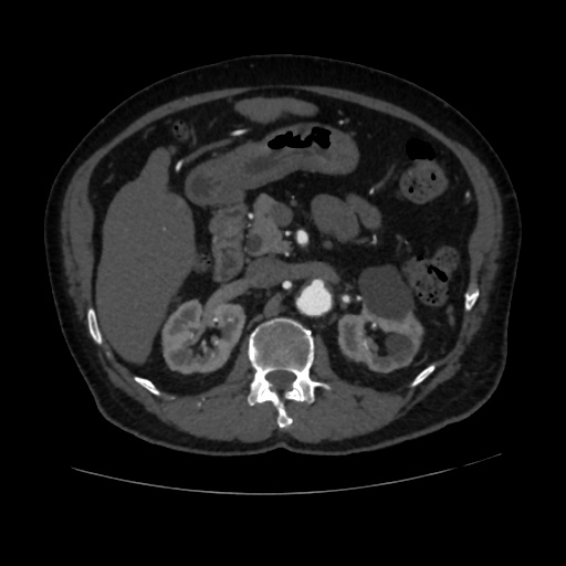 File:Abdominal aortic aneurysm (Radiopaedia 57318-64259 Axial C+ arterial phase 26).jpg
