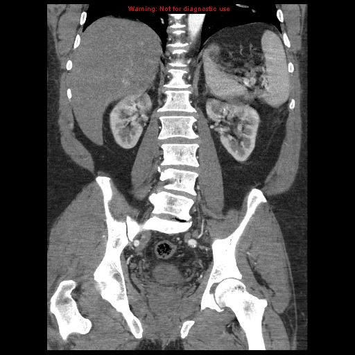 File:Abdominal aortic aneurysm (Radiopaedia 8190-9038 Coronal C+ arterial phase 84).jpg