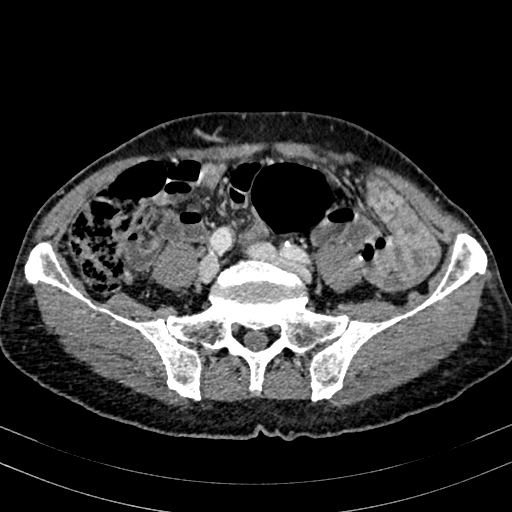 File:Abdominal aortic aneurysm (Radiopaedia 83581-98689 Axial C+ portal venous phase 78).jpg