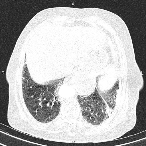 Abdominal aortic aneurysm (Radiopaedia 85063-100606 Axial lung window 52).jpg