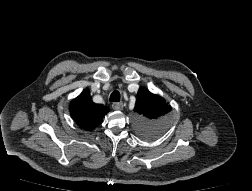 Abdominal aortic aneurysm rupture (Radiopaedia 54179-60362 Axial C+ portal venous phase 52).jpg