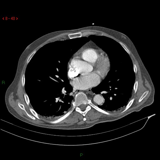 Abdominal aortic aneurysm rupture with aortocaval fistula (Radiopaedia 14897-14841 Axial C+ arterial phase 40).jpg