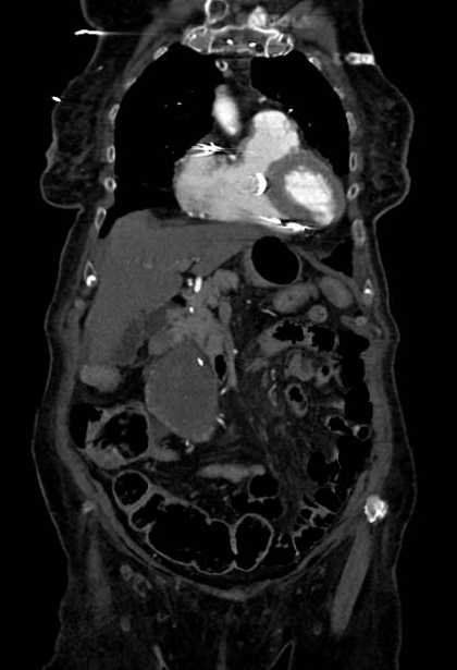 Abdominal aortic aneurysm with thrombus fissuration (Radiopaedia 73192-83919 Coronal C+ arterial phase 15).jpg
