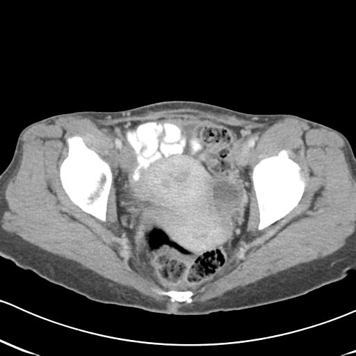 File:Abdominal desmoid tumor (Radiopaedia 41007-43740 Axial C+ portal venous phase 65).png