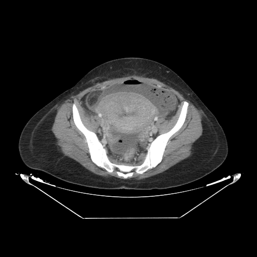 Abdominal gossypiboma- surgical towel (Radiopaedia 57288-64226 Axial C+ portal venous phase 62).jpg