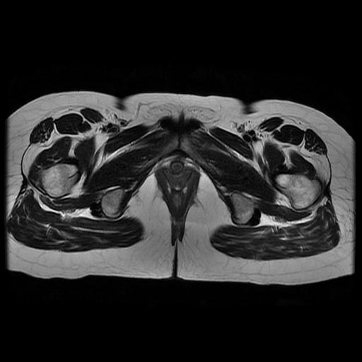 File:Abdominal wall endometriosis (Radiopaedia 83702-98847 Axial T2 19).jpg
