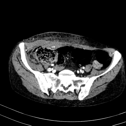 File:Abdominal wall hematoma with active bleeding (Radiopaedia 83915-99117 Axial renal cortical phase 99).jpg