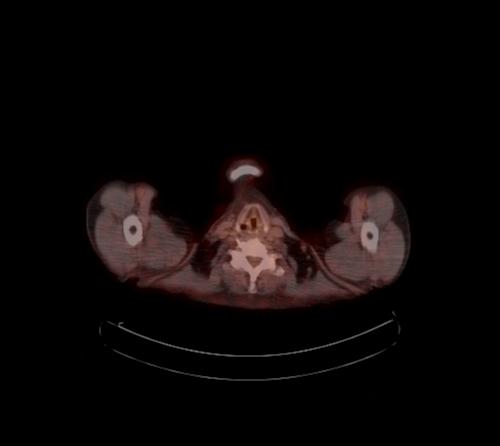 File:Abdominal wall metastasis from colorectal carcinoma (Radiopaedia 31016-31719 C 134).jpg