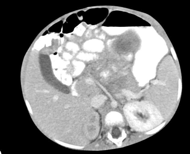 Abdominopelvic rhabdomyosarcoma (Radiopaedia 78356-90984 Axial C+ portal venous phase 63).jpg