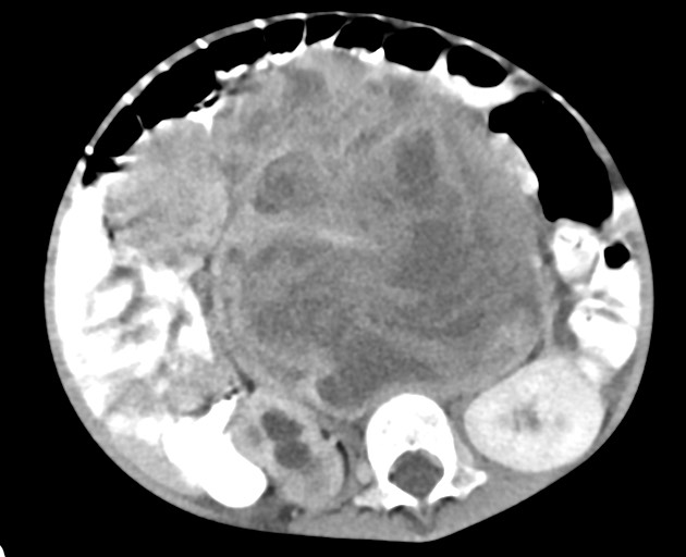 File:Abdominopelvic rhabdomyosarcoma (Radiopaedia 78356-90984 Axial C+ portal venous phase 92).jpg