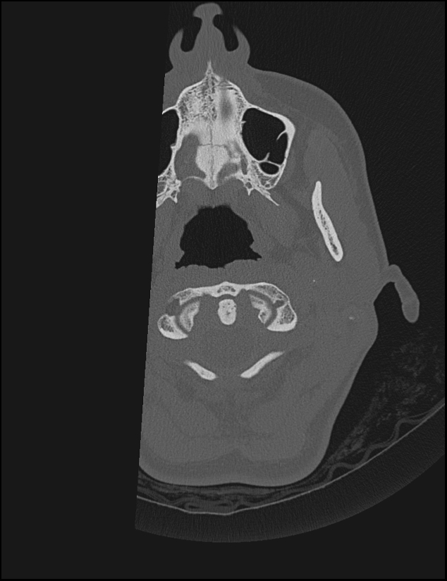 Aberrant right internal carotid artery (Radiopaedia 65191-74198 Axial non-contrast 1).jpg