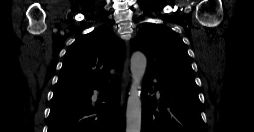 Accesory rib joint (Radiopaedia 71987-82452 Coronal bone window 5).jpg
