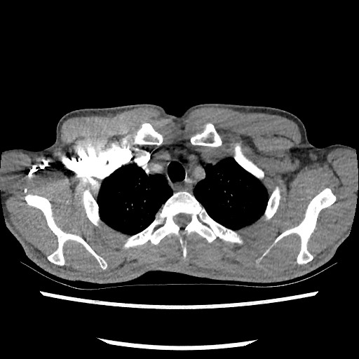 Accessory left horizontal fissure with lingular pneumonia (Radiopaedia 53763-59843 Axial C+ CTPA 16).jpg