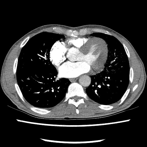 Accessory left horizontal fissure with lingular pneumonia (Radiopaedia 53763-59843 Axial C+ CTPA 60).jpg