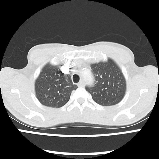 Accessory left horizontal fissure with lingular pneumonia (Radiopaedia 53763-59843 Axial lung window 14).jpg