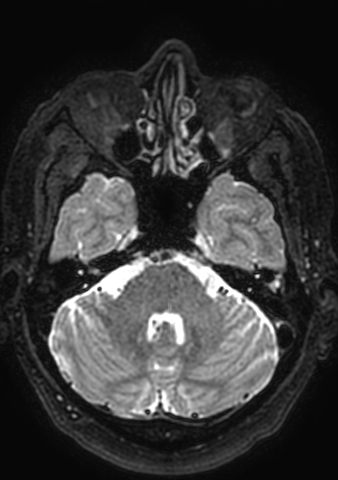 Accessory middle cerebral artery (Radiopaedia 73114-83828 Axial T2 159).jpg