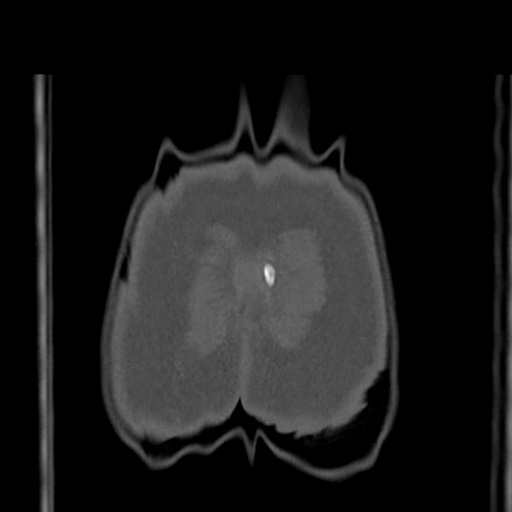 File:Acetabular and ilial fractures (Radiopaedia 59084-66378 Coronal bone window 58).jpg