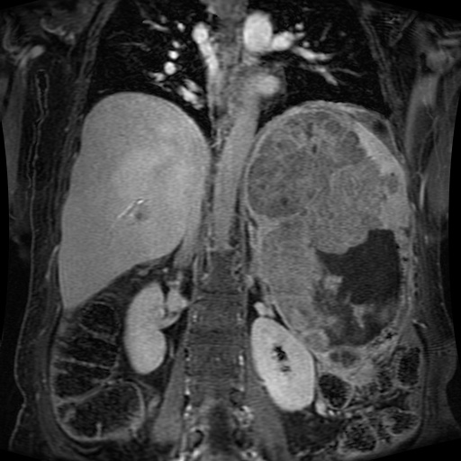 Acinar cell carcinoma of the pancreas (Radiopaedia 75442-86668 Coronal T1 C+ fat sat 80).jpg