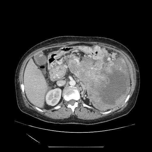 File:Acinar cell carcinoma of the pancreas (Radiopaedia 75442-86669 Axial C+ portal venous phase 48).jpg