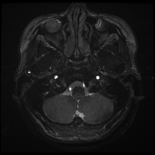 Acoustic neuroma (Radiopaedia 34049-35283 Axial 8).png