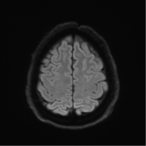 File:Acoustic schwannoma (Radiopaedia 50846-56358 Axial DWI 52).png