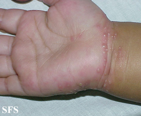 Acropustulosis Infantile (Dermatology Atlas 4).jpg