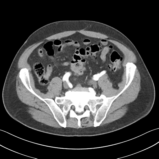 File:Active diverticular hemorrhage (Radiopaedia 39415-41725 Axial C+ arterial phase 48).png