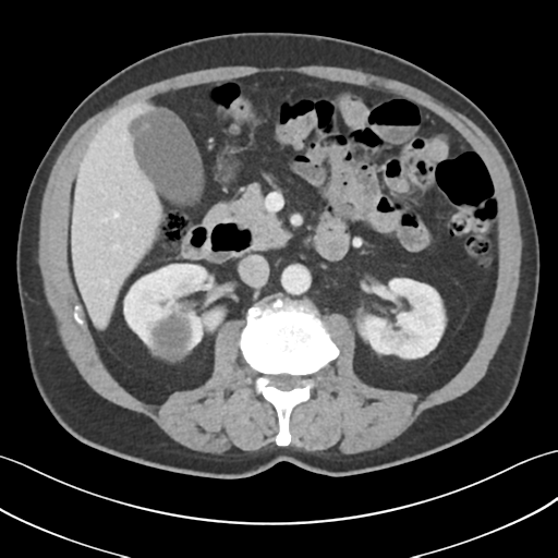 File:Active diverticular hemorrhage (Radiopaedia 39415-41725 Axial C+ portal venous phase 26).png