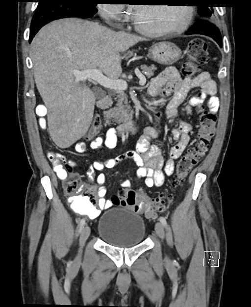 Active lower gastrointestinal bleeding - diverticular (Radiopaedia 61203-69106 Coronal C+ portal venous phase 57).jpg