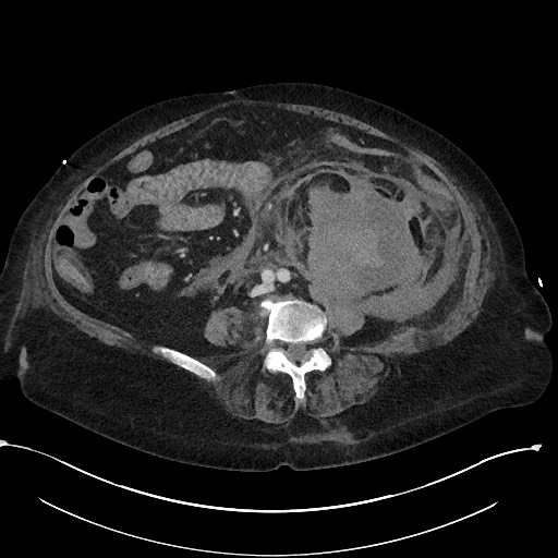 File:Active renal extravasation with large subcapsular and retroperitoneal hemorrhage (Radiopaedia 60975-68796 Axial 224).jpg