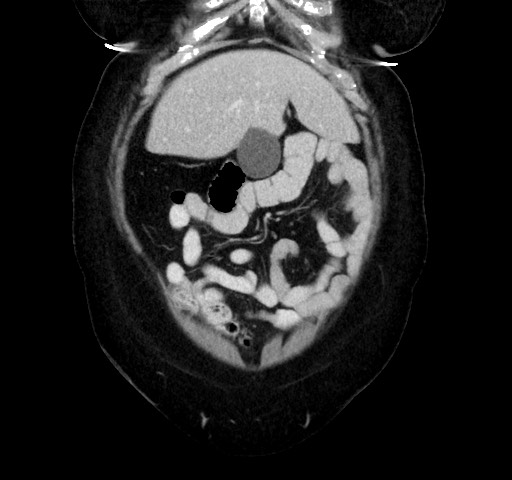 Acute appendicitis, heterotaxy syndrome (Radiopaedia 66884-76202 Coronal C+ portal venous phase 24).jpg