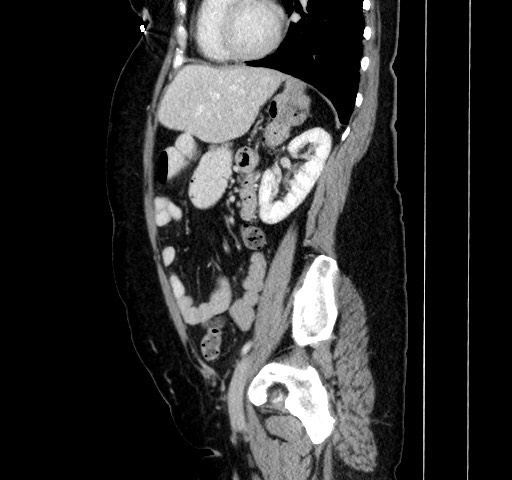 Acute appendicitis, heterotaxy syndrome (Radiopaedia 66884-76202 Sagittal C+ portal venous phase 90).jpg