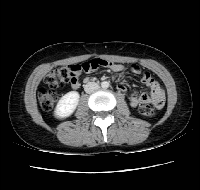 Acute appendicitis (Radiopaedia 22892-22918 Axial C+ portal venous phase 41).png