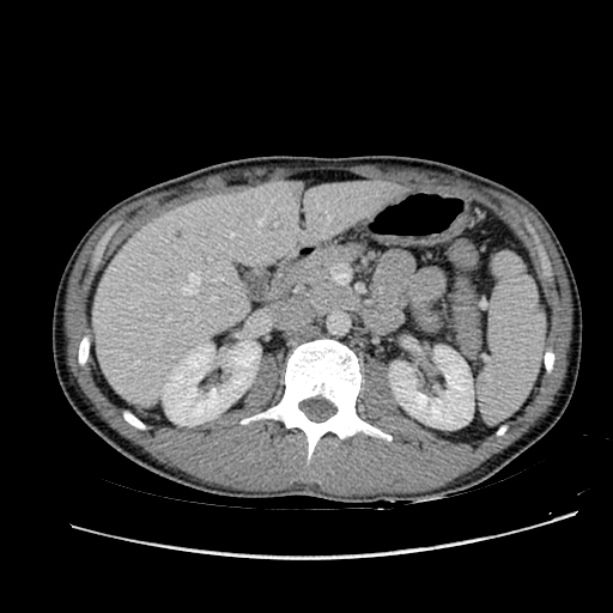 Acute appendicitis (Radiopaedia 27049-27227 Axial C+ portal venous phase 25).jpg