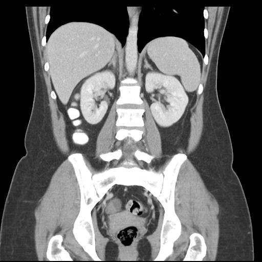 File:Acute appendicitis (Radiopaedia 30297-30934 Coronal C+ portal venous phase 30).jpg