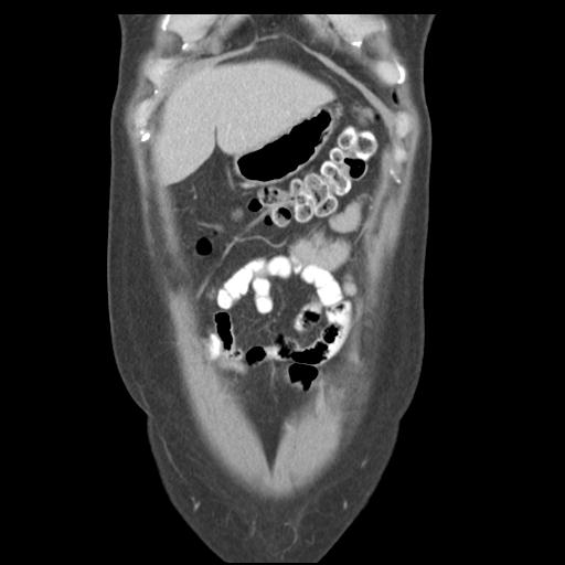 File:Acute appendicitis (Radiopaedia 30297-30934 Coronal C+ portal venous phase 9).jpg