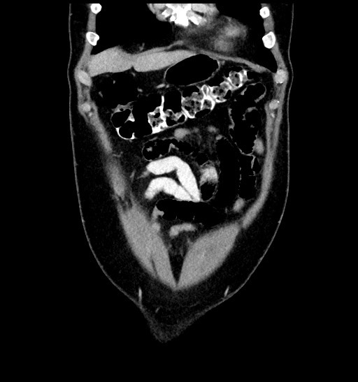 Acute appendicitis (Radiopaedia 77016-88960 Coronal C+ portal venous phase 25).jpg