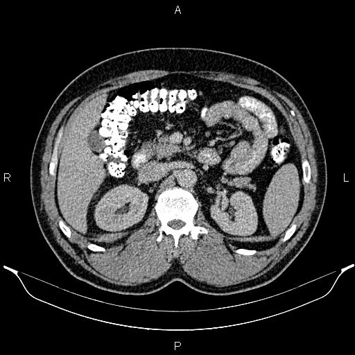 File:Acute appendicitis (Radiopaedia 84780-100240 Axial C+ portal venous phase 38).jpg