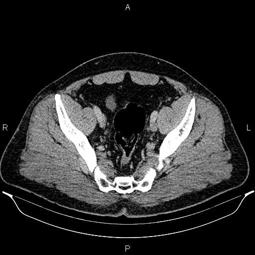 Acute appendicitis (Radiopaedia 84780-100240 Axial C+ portal venous phase 92).jpg